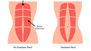 A picture demonstrating diastasis recti abdominis.