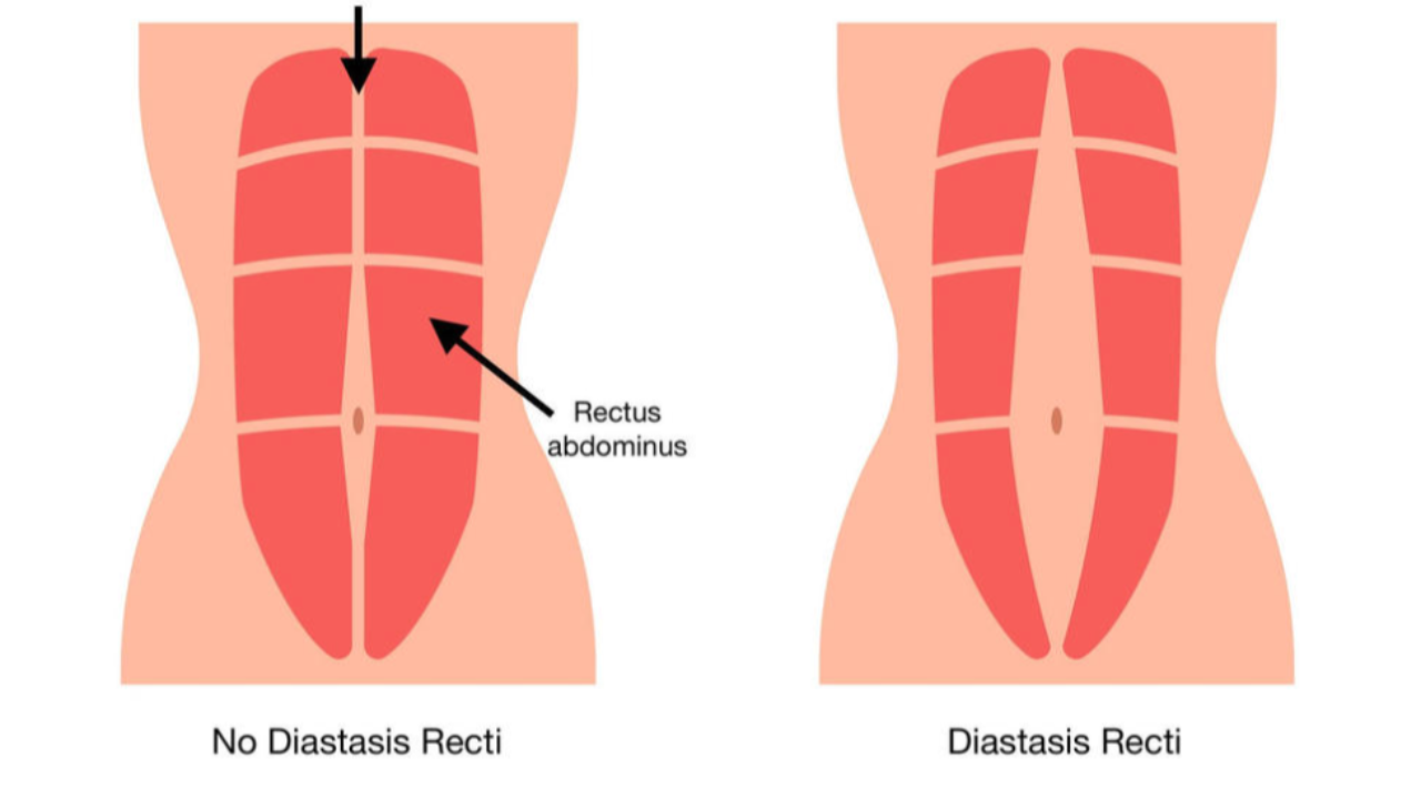 A picture demonstrating diastasis recti abdominis.